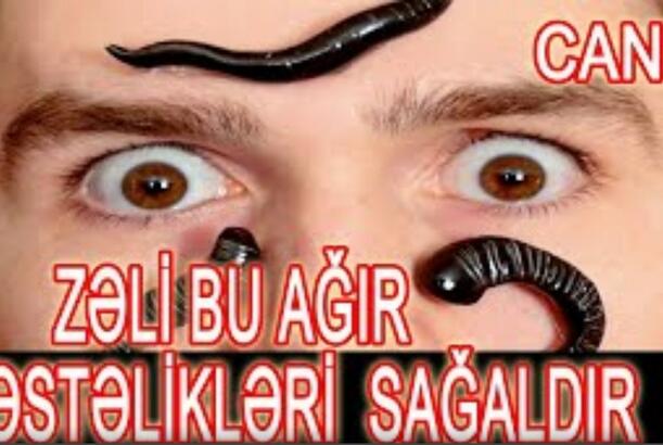 Diqqət: Zəli ilə müalicə bu ağır xəstəlikləri sağaldır