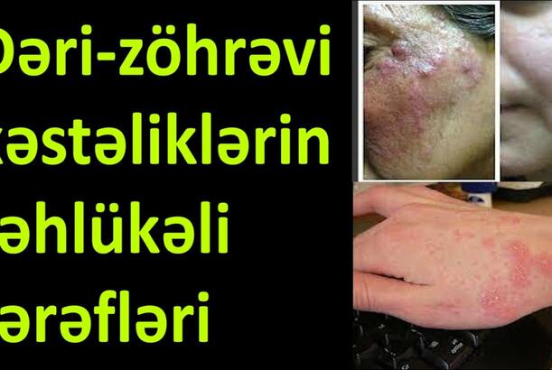 Dəri-zöhrəvi xəstəliklərinin təhlükəli tərəfləri - Tanınmış mütəxəssis sualları cavablandırır