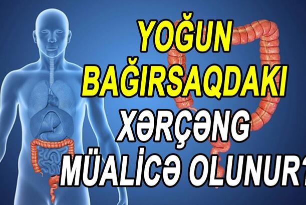 Yoğun bağırsaqdakı xərçəng müalİcə olunur?