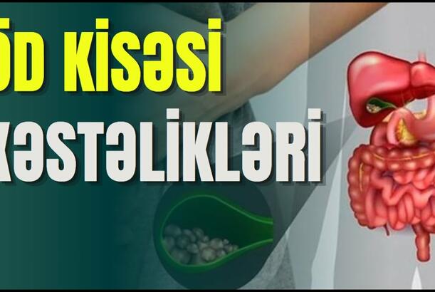 Öd kisəsində polip nədir, müalicəsi necə aparılır?